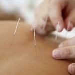 acupuncture, needles, treat back pain